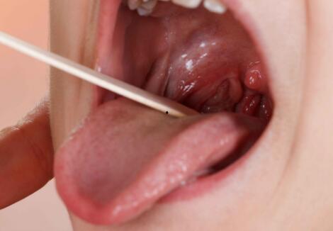 扁桃体结石视频,视频带你直观了解症状与防治方法