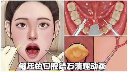 扁桃体结石视频,视频带你直观了解症状与防治方法