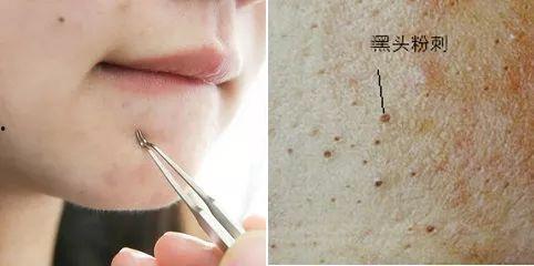 清理黑头粉刺视频,跟我学视频清洁术