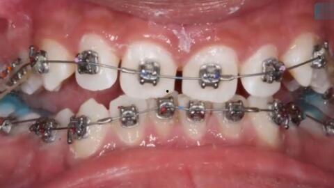 牙视频,揭秘口腔健康与美丽笑容的秘密