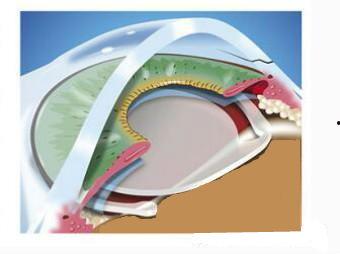 白内障手术全过程视频,从术前准备到术后恢复