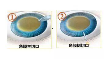 白内障手术全过程视频,从术前准备到术后恢复