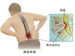 腰椎间盘突出按摩手法视频,专业指导，轻松缓解腰痛