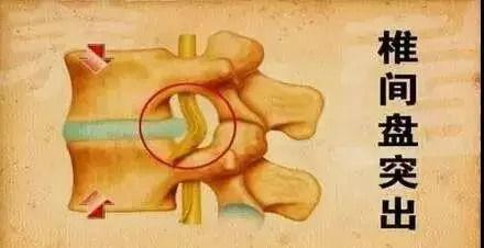 腰椎间盘突出按摩手法视频,专业指导，轻松缓解腰痛