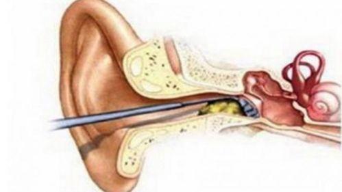赵医生掏耵聍最难视频,惊险瞬间全程记录