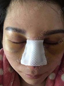 鼻综合拆线视频,专业视频带你直观了解
