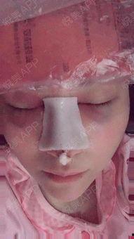 鼻综合拆线视频,专业视频带你直观了解