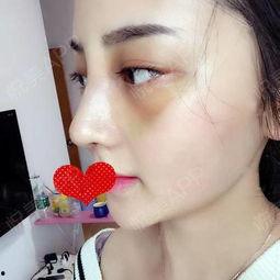 鼻综合拆线视频,专业视频带你直观了解