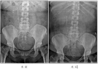 输尿管镜取石术视频,输尿管镜取石术操作流程及要点解析
