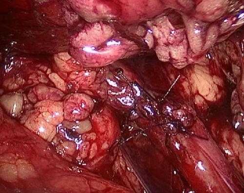 输尿管镜取石术视频,输尿管镜取石术操作流程及要点解析