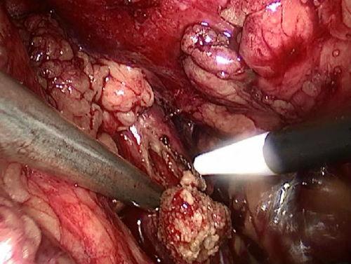 输尿管镜取石术视频,输尿管镜取石术操作流程及要点解析