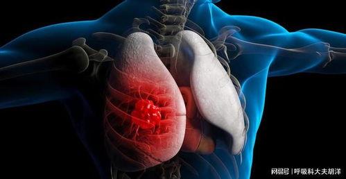 肺癌视频,病因、症状与防治策略