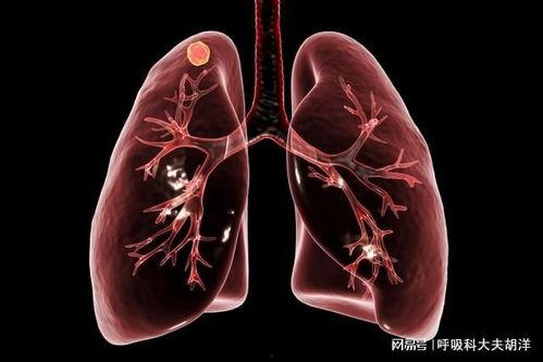 肺癌视频,病因、症状与防治策略