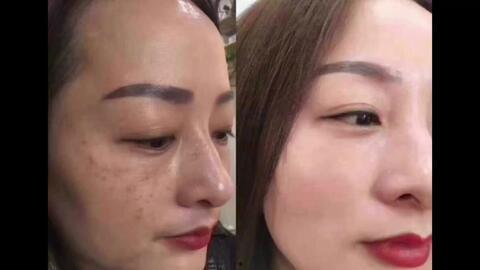 祛斑视频,跟随视频轻松告别斑点困扰