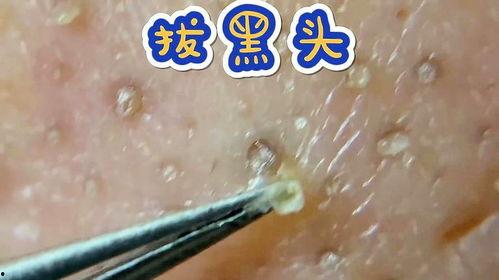 拔黑头视频,告别毛孔粗大