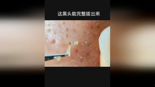 拔黑头视频,告别毛孔粗大